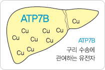 윌슨병 스크리닝