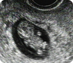 임신 초기의 초음파 검사