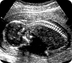 임신 중기의 초음파 검사