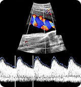 도플러 초음파 검사